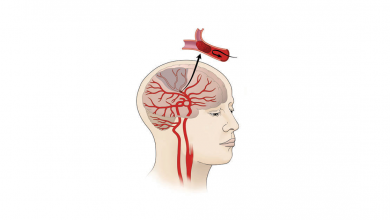 Photo of मस्तिष्काघात : ‘समयमै विशेषज्ञ उपचार पाए पूर्ववत् अवस्थामा फर्किन सकिन्छ’