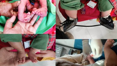 Photo of जन्मदै बाङ्गो खुट्टा भएको बच्चाको जिल्ला अस्पतालमै सफल उपचार